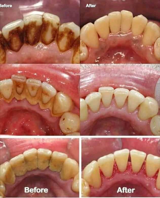 Plaque is a soft, sticky film of bacteria that forms on teeth and can lead to cavities and gum disease and Tartar is hardened plaque that cannot be removed through regular brushing and flossing.