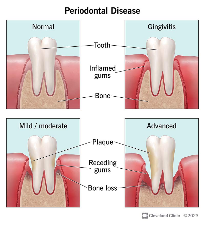 The removal of irritants like plaque and tartar allows the gums to heal and Inflammation and redness of the gums usually subside after scaling